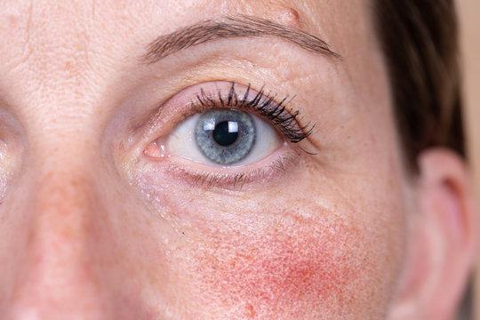 A mature Caucasian woman is seen up close, suffering with severe rosacea in the cheek. Superficial blood vessels cause red and blotchy skin in the face.