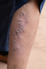 A severe case of varicose veins is seen in the leg of an older Caucasian person. A close up view on...