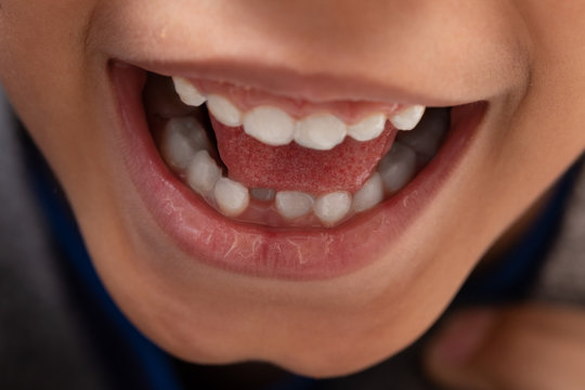 A closeup view on the mouth of a happy kid with a toothy smile. Missing milk teeth are seen as new teeth grow through gums.