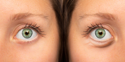 Naklejka premium A before and after view on the green eyes of a pretty Caucasian girl suffering from fluid retention beneath the eye. Results of a successful blepharoplasty.