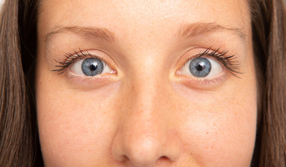 A closeup view of a young and pretty Caucasian woman with blue eyes, suffering from strabismus. A...