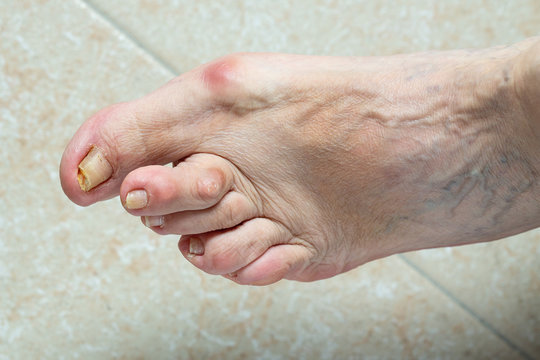 A close up and top view on the foot of old-aged woman suffering from severe hallux valgus (bunion) causing pain and discomfort in the feet.