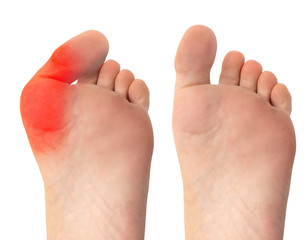 A before and after view of successful surgery to remove a severe bunion from the foot of a...