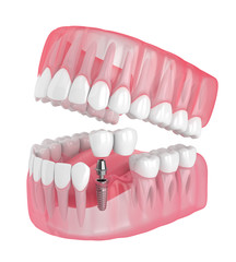 3d render of jaw with implant supported dental cantilever bridge