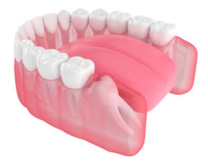 3d render of jaw with wisdom mesial impaction