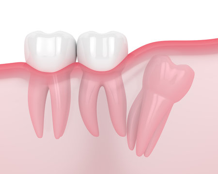 3d render of jaw with wisdom distal impaction