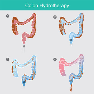 Colon Hydrotherapy..The secreted of waste that accumulates in the colon wall for a long time,.Can use the removal method by inserting water solution hose to flush colon.