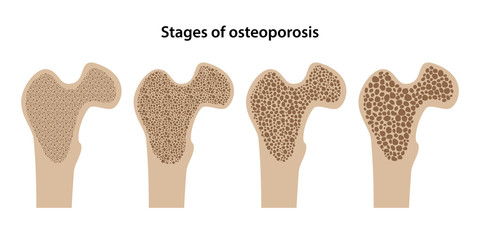 Stages of osteoporosis are isolated on white background. Vector illustration in flat style