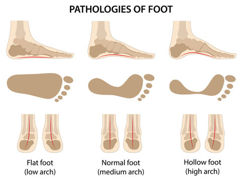 Pathologies of foot. Flat foot. Difference between sick and healthy feet. Vector illustration in flat style over white background