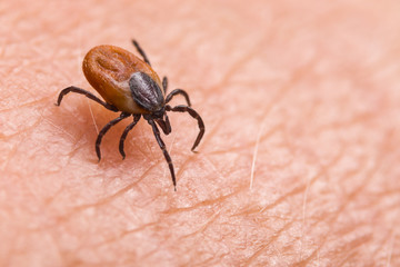 Infected female deer tick on hairy human skin. Ixodes ricinus. Parasitic mite. Acarus. Dangerous...