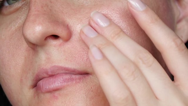 Close-up of a female face. The girl applies makeup: a cream, a serum or a cure for acne. Problem skin and care.