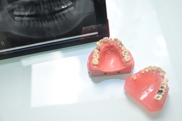 歯科模型とレントゲン写真