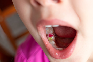 A girl showing her colorful filling in milk teeth. - 279179159