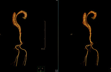 Computer tomography angiography :CTA of whole body scan with 3D reconstruction .CT angiography for determine vascular disease / trauma . Technology Concept.