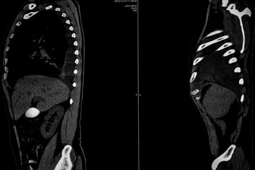 Computer tomography angiography :CTA of whole body scan with 3D reconstruction .CT angiography for determine vascular disease / trauma . Technology Concept.