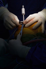 Team of doctor working at operating room in hospital. Surgeon perform total knee replacement surgery. Incision was made on patient 's knee in the case of osteoarthritis.Medical and orthopedic concept.