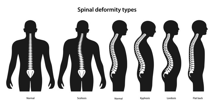 Spinal deformity types. White spine on a black body. Anterior view and lateral view of human body. Anatomical vector illustration in flat style isolated over white background.