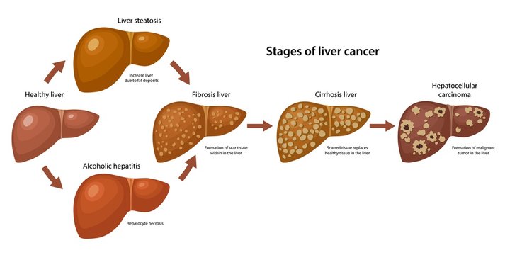 Stages of liver cancer with description corresponding steps: healthy, fatty, fibrosis, alcoholic hepatitis, cirrhosis and cancer liver. Vector illustration in flat style isolated over white background