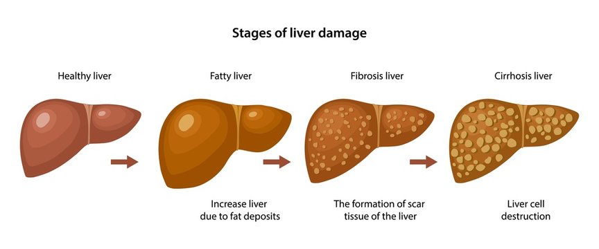 Stages of liver damage with description corresponding steps: healthy, fatty, fibrosis and cirrhosis liver. Anatomical vector illustration in flat style isolated over white background