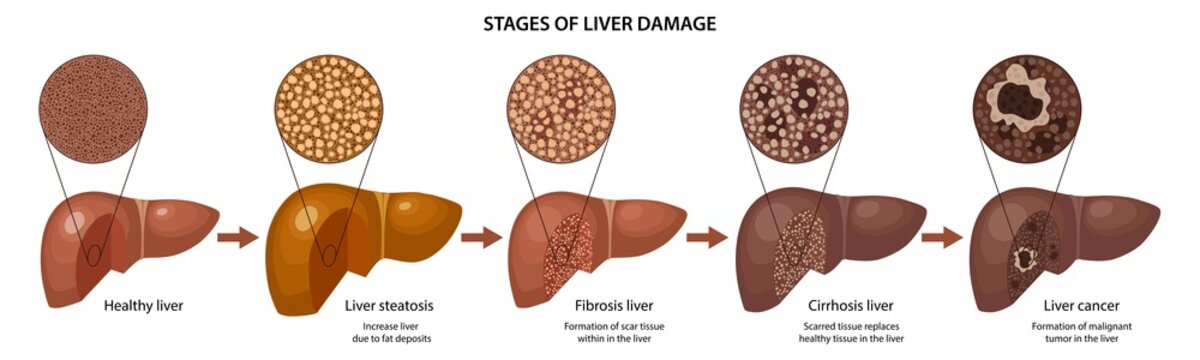 Stages of liver damage with description corresponding steps: healthy, fatty, fibrosis, cirrhosis and cancer liver. Vector illustration with histology in flat style isolated over white background
