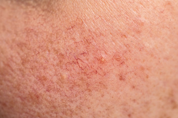 Fototapeta premium Extreme close up of skin of human suffering from blotchiness, macro of red vessels