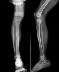 Radiography of Tibial fracture at mid shaft of the bone in young boy patient.