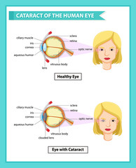 Scientific medical illustration of cataract of human eye