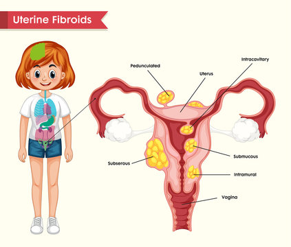 Scientific medical illustration of uterine fibroids