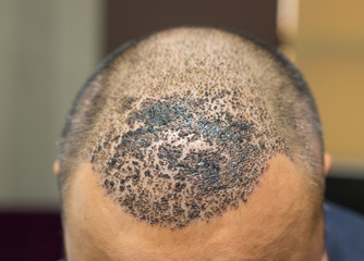 Top view of a man's head with hair transplant surgery. Bald head of hair loss treatment