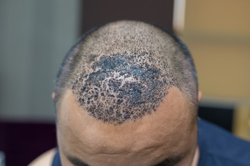 Top view of a man's head with hair transplant surgery. Bald head of hair loss treatment