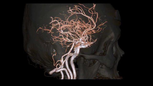 CTA Brain or computed tomography angiography of the brain 3D Rendering image showing  cerebral artery of the brain with transparent bone rotating on the screen .