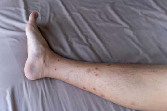 Close Up Of A Man Leg With Allergy To Insect, Mosquito, Or Bug Bites Isolated. Itchy Skin Rash. Human Organ Part.