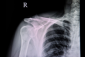 chest xray of a patient with old ribs fracture