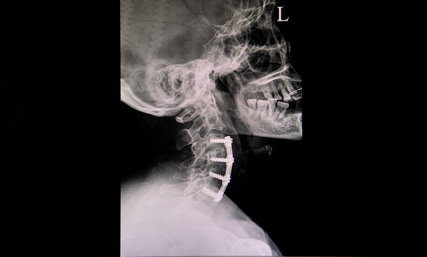 Xray film of a neck of a patient with plate and screws fixations
