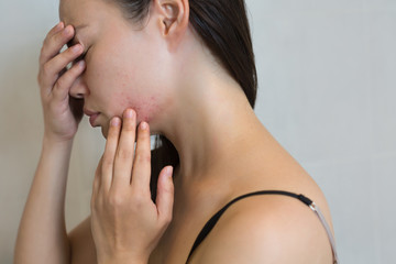 Fototapeta premium Woman stressed from face acne.