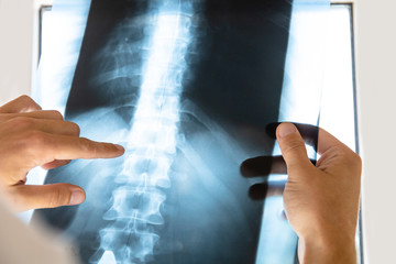 doctor examines x-ray picture of human spine - obrazy, fototapety, plakaty
