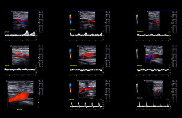 Ultrasound doppler for finding  deep vein thrombosis of lower extremity.