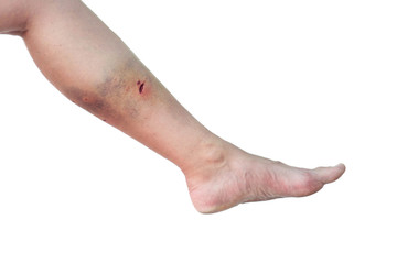 Caucasian woman's leg with a dog bite wound in the calf on isolated white background. Female leg...