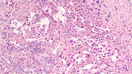 Lung cancer - adenocarcinoma: Therapies for specific genetic mutations (biomarkers EGFR, ALK, ROS1, BRAF, PDL1, KRAS) are appropriate for selected cases. - obrazy, fototapety, plakaty