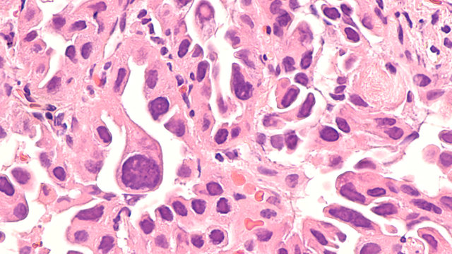 Lung Cancer - Adenocarcinoma: Therapies For Specific Genetic Mutations (biomarkers EGFR, ALK, ROS1, BRAF, PDL1, KRAS) Are Appropriate For Selected Cases.