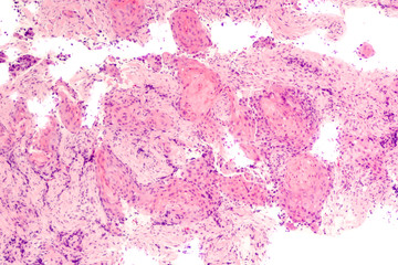 Lung Cancer: Photomicrograph of a CT (CAT) scan-guided needle core biopsy showing pulmonary...