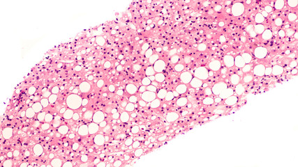 Photomicrograph of liver biopsy pathology histology (pathology) showing steatosis (
