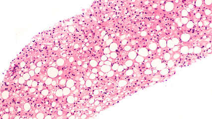 Photomicrograph of liver biopsy pathology histology (pathology) showing steatosis ("fatty liver"), which may be associated with diabetes mellitus, alcohol abuse, or toxins. 