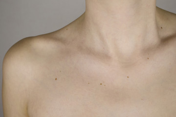 Naklejka premium Neck and collarbone of a girl with a lot of moles on the skin