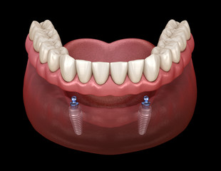 Mandibular removable prosthesis All on 2 system supported by implants with ball attachments. Medically accurate dental 3D illustration