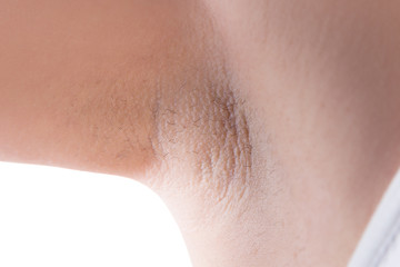 Armpit skin after laser hair removal