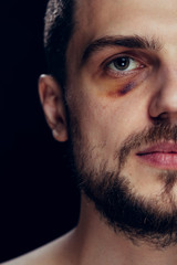 Violence fight eye hematoma shiner close-up. Portrait of a man with bruised skin and black eye.