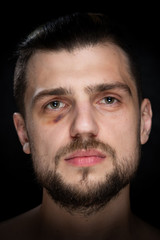 Sad young man with black bruise eye portrait. Violence victim concept.