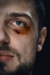 Man with eye hematoma bruise. Beaten agression victim with black eye.