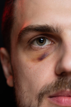 Man with shiner bruise black eye hematoma